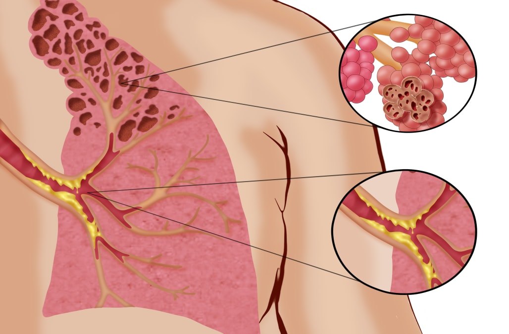 Study links e cigarettes to incurable disease called Popcorn Lung